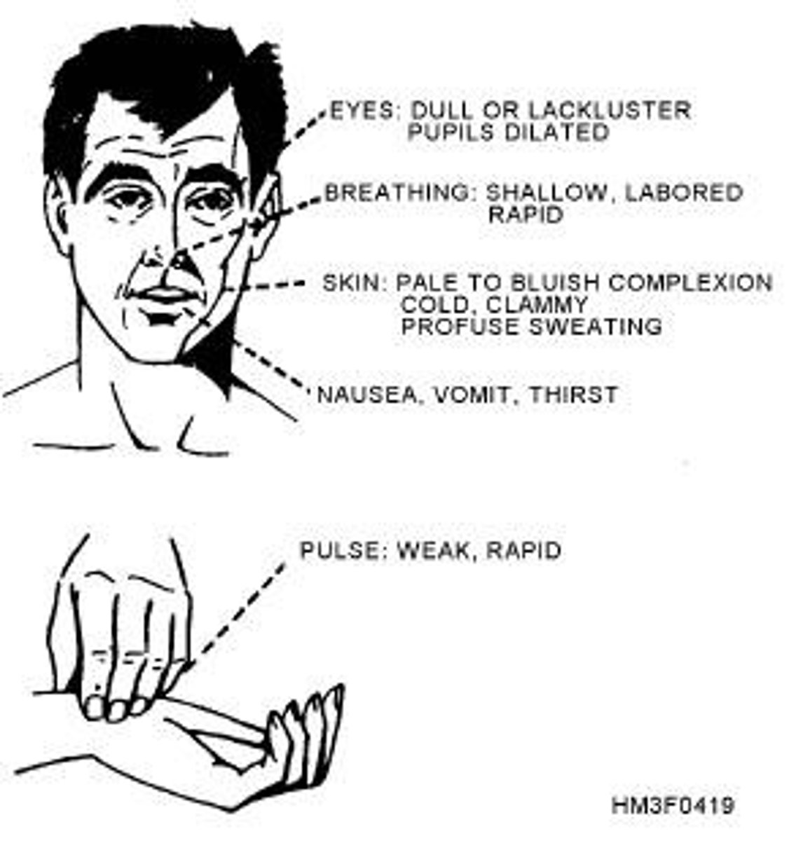 <p>anxious, restless, lethargic (slow-moving), unconscious, pale and cold skin, nauseous or vomiting, increased pulse and respiration rates, bluish tinge to skin, thirsty, dilated (enlarged) pupils</p>