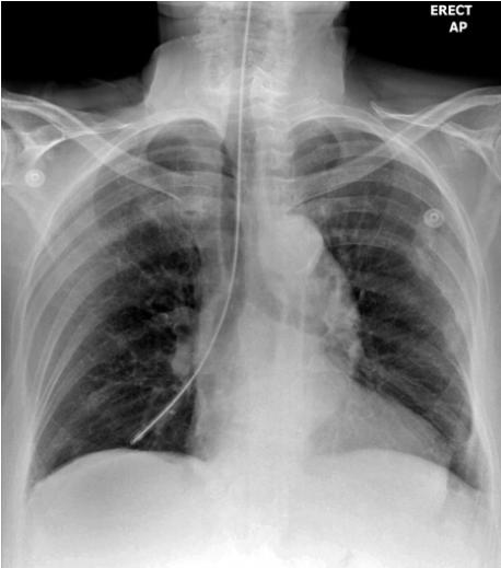 <p>Right bronchus, lung, or coiled in the esophagus.</p>