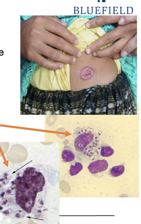 <ul><li><p class=""><strong>Bone marrow macrophages</strong> with <strong>intracellular amastigotes</strong></p></li><li><p class="">Occasionally seen in <strong>peripheral macrophages</strong></p></li><li><p class=""><strong>Serum antibodies</strong> may be present in visceral disease</p></li></ul><p></p>