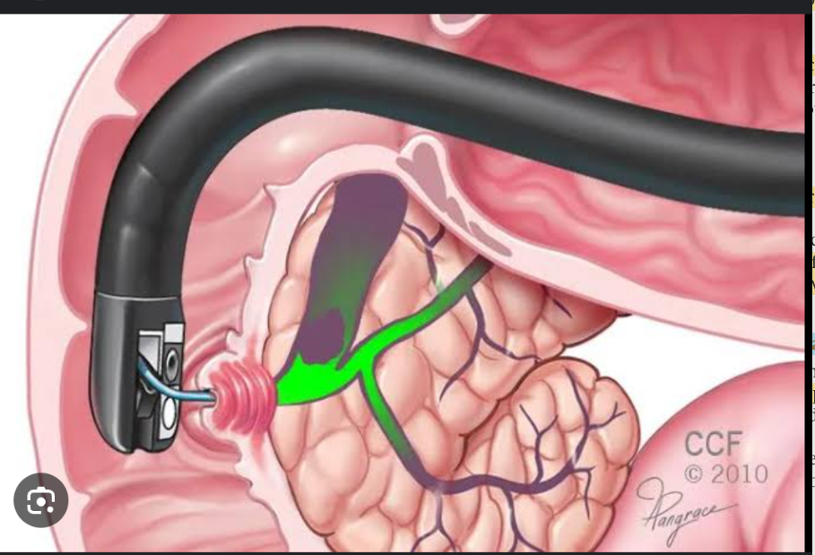 <p>combines endoscopy and radiography to visualize the biliary system and pancreas. An endoscope is inserted in the esophagus and advanced to the point where the bile duct and pancreatic duct open in the duodenum; contrast dye is injected into the ducts. Radiography is performed to visualize the ducts.</p>