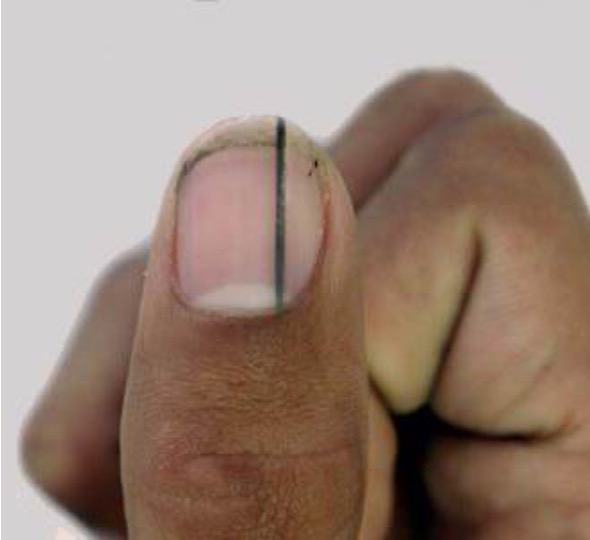 <p>line through nail; can be benign or malignant</p>