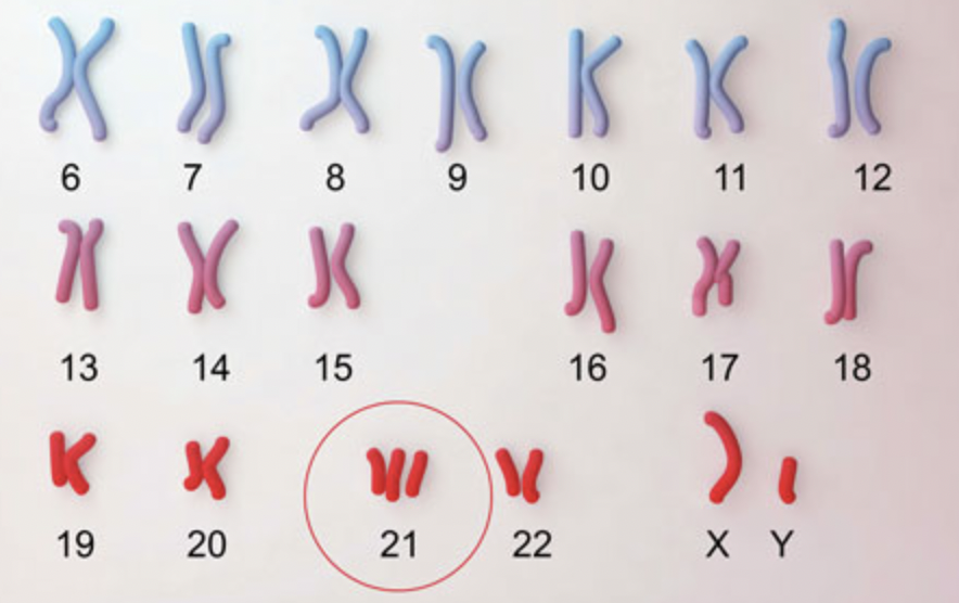 <p>A chromosomal mutation where an individual has an extra chromosome 21 (47 chromosomes total).</p>