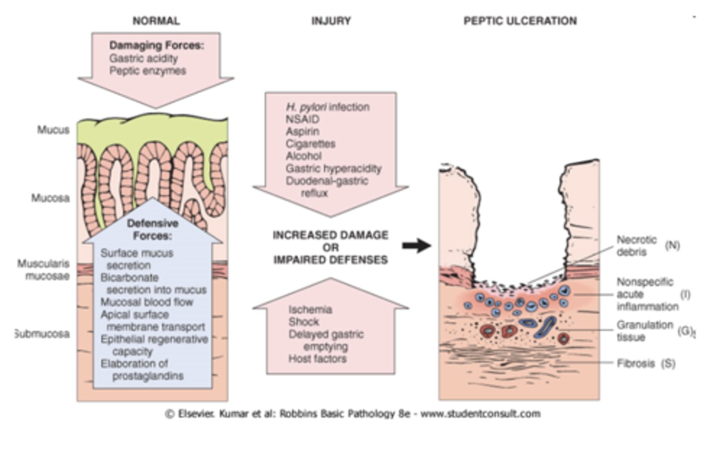 <p>adequate protection requires normal secretion of BOTH Mucus &amp; HCO3-</p><p>- impairment of either may result in mucosal damage and the development of Gastritis and possibly Peptic Ulcer Disease</p><p>- various factors can reduce their secretion, including aspirin and other NSAIDS along with some ⍺-adrenergic agonists</p>