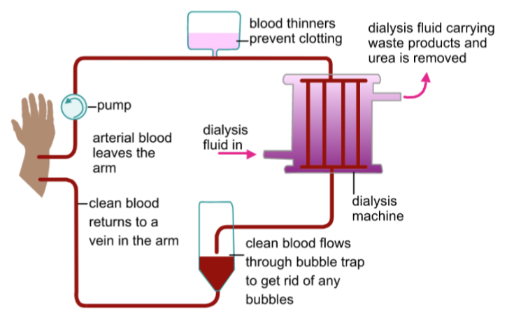 <p>Blood is pumped into the dialysis machine &amp; passes through tubes with a partially permeable membrane</p><p>Dialysis fluid surrounds the tubes, containing the same concentration of salts &amp; sugars as the blood, however it contains no urea</p><p>Therefore urea diffuses from the blood into the dialysis fluid because particles are moving from an area of high concentration to an area of low concentration</p><p>Proteins &amp; blood cells are too big to pass through the partially permeable membrane, so they remain in the blood</p><p>The ‘cleaned’ blood then is pumped back into the patient </p>