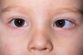 <p>This is a picture of the following condition:</p>