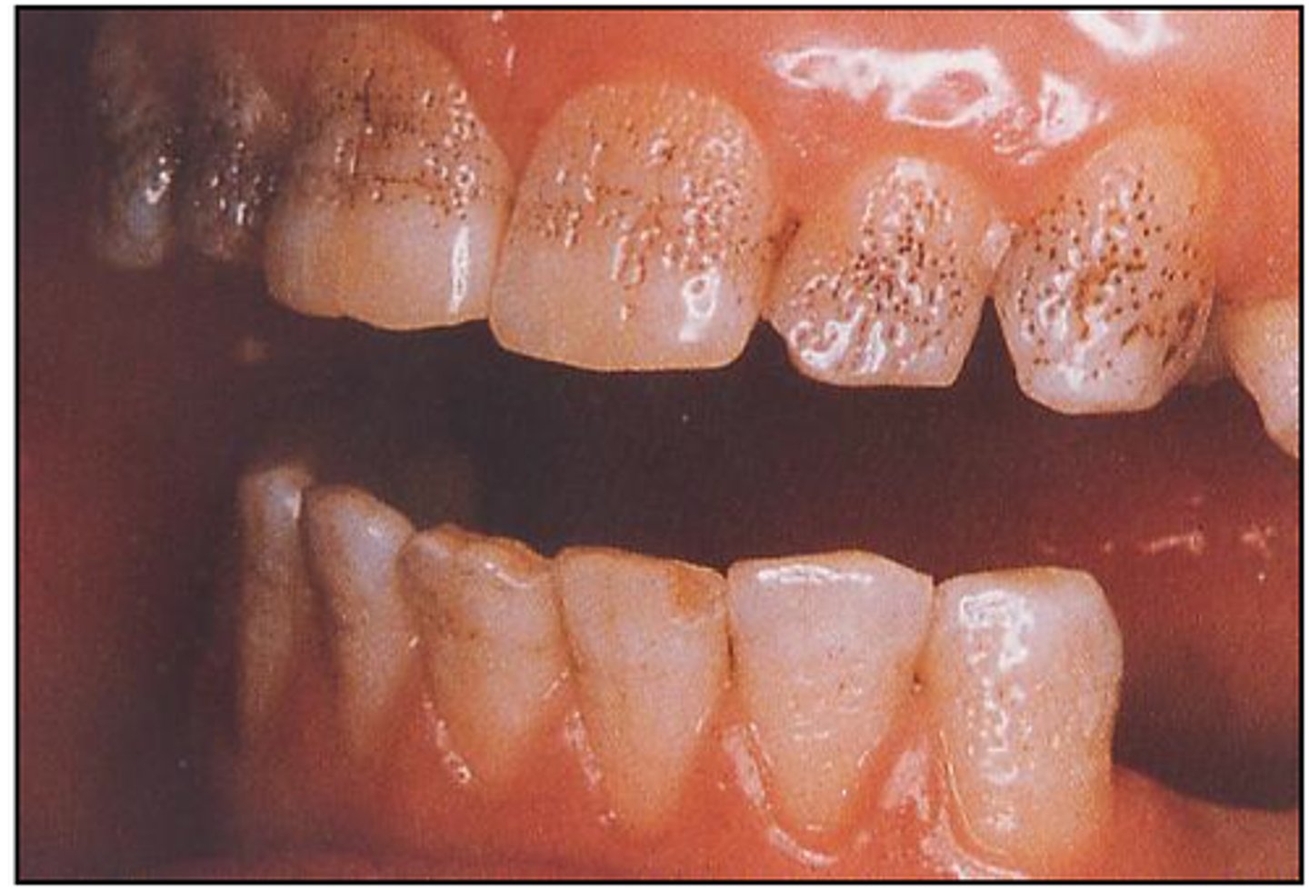 <p>what condition is shown in the picture?</p><p>a. dentinogenesis imperfecta</p><p>b. fluorosis</p><p>c. amelogenesis imperfecta</p><p>d. tetracycline</p>
