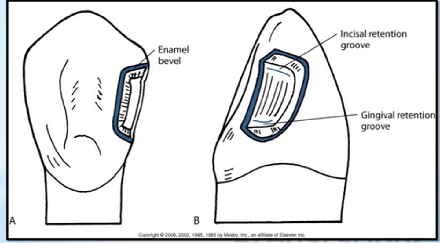 <p>- beveling of accessible enamel margin for added retention</p><p>- no beveling of gingival box or lingual surface</p>