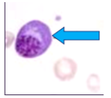 <p><span style="background-color: transparent; font-family: "Times New Roman", serif;">*<strong>Malignant neoplasm of plasma cells</strong> </span></p><p><span style="background-color: transparent; font-family: "Times New Roman", serif;">*Involves many bones in the body: vertebrae, ribs, skull, jaw (5-30%)</span></p><p><span style="background-color: transparent; font-family: "Times New Roman", serif;">*<strong>40+ years</strong></span></p>