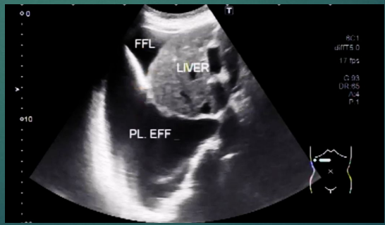 <ul><li><p>fluid collection between the lungs and the chest wall </p></li><li><p>superior to the diaphragm</p></li></ul><p></p>