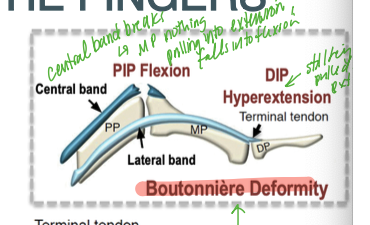 <p>boutonniere deformity as the PIP is no longer held into extension and falls into flexion, with the lateral band intact and pulling the DIP into hyperextension</p>