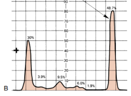 <p>Determine the condition of the patient given the serum electrophoresis graph</p><img src="https://knowt-user-attachments.s3.amazonaws.com/18d01851-97be-44d5-a3d7-15385b0f3daa.png" alt="knowt flashcard image"><p>A. Nephrotic Syndrome</p><p>B.&nbsp;Inflammation</p><p>C.&nbsp;Monoclonal gammopathy</p><p>D.&nbsp;Liver Cirrhosis</p><p>E. NOTA</p>