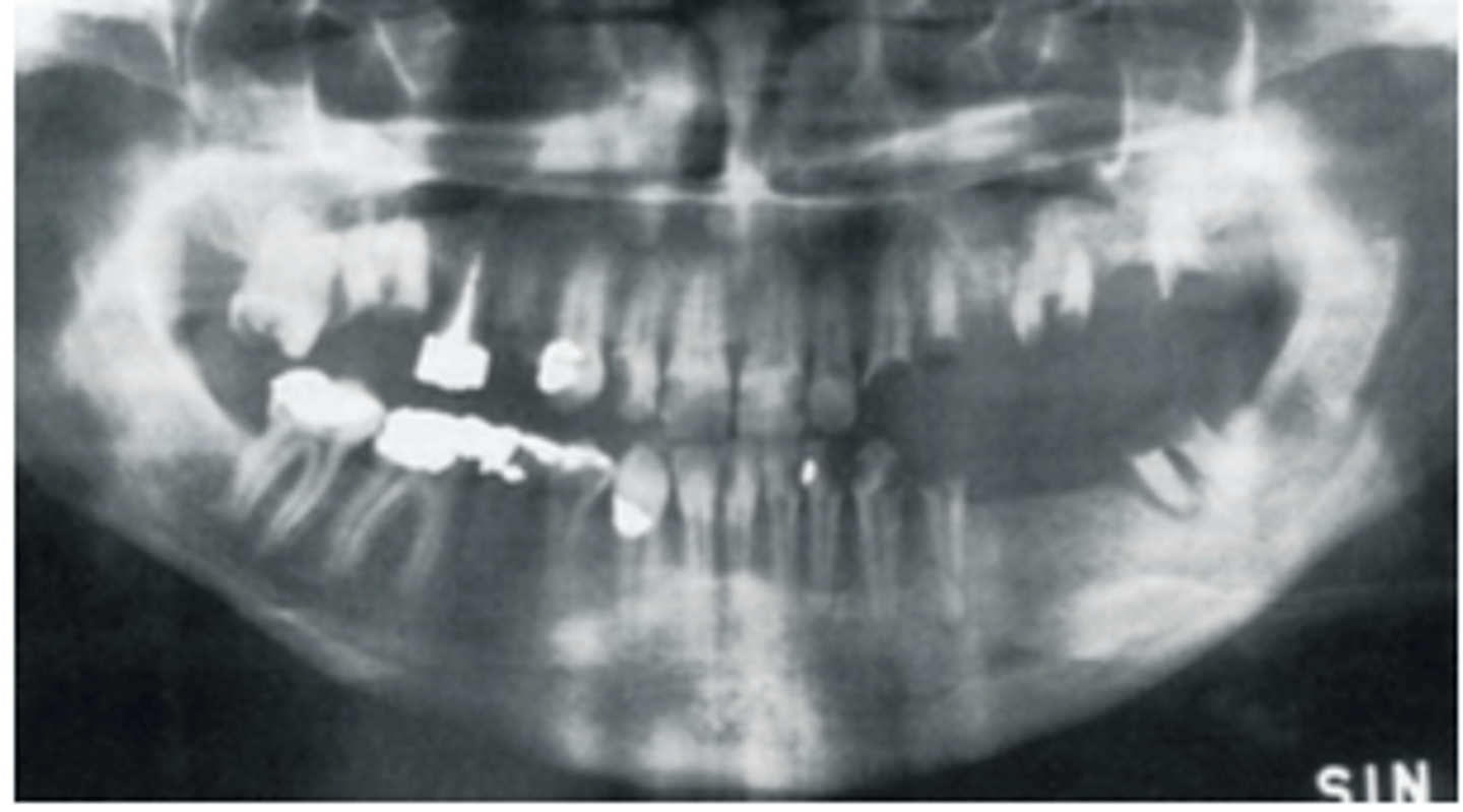 <p>Q: Which side of this patient had radiation therapy?</p><p>A: left side</p>