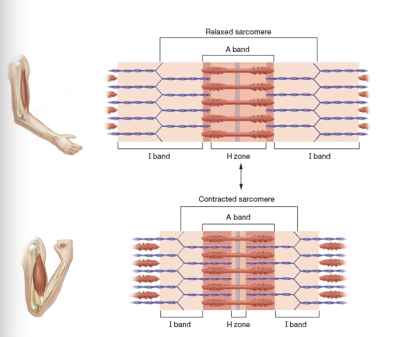 <p>Sarcomeres are contracted to the A band, bringing z discs closer together </p>