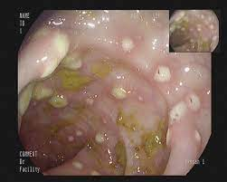 <p>E. HISTOLYTICA DISEASE/S: INFLAMMATORY OR G<strong>RANULOMATOUS TUMORLIKE MASS</strong> IN THE <u>INTESTINE</u></p>