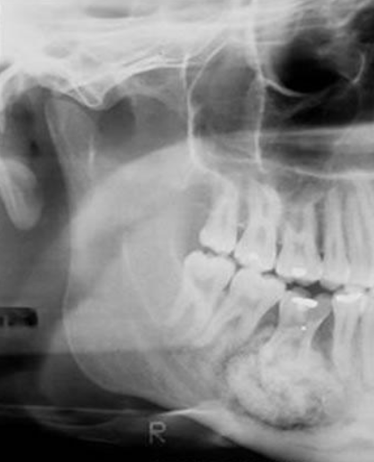 <p>Well-defined or ill-defined radiopaque lesion (can be mixed RO and RL)</p>