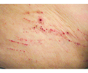 <p>self-inflicted abrasion; superficial; scratches from intense itching</p>