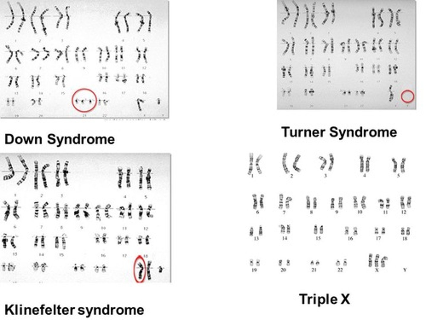 <p>I. Down Syndrome - (B) 47 total chromosomes, Trisomy of chromosome 21</p><p>II. Turner Syndrome - (C) 45 total chromosomes, XO</p><p>III. Klinefelters - (A) 47 total chromosomes, XXY</p>
