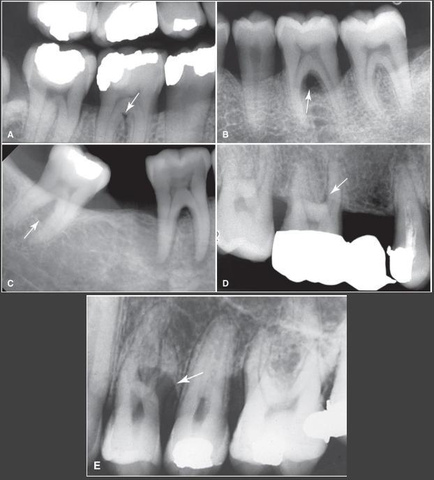 <ul><li><p>Apical extent of bone loss to and beyond furcation level of multirooted teeth</p></li><li><p>Widening of PDL space at apex of bony crest of furcation</p><ul><li><p>More radiolucent appearing furcation area</p></li></ul></li><li><p>Can be masked by external oblique ridge or root morphology</p></li><li><p>Harder to see around maxillary molars (palatal root)</p><ul><li><p>Most commonly involved maxillary 1st molar furcation is mesial</p></li><li><p>J shape radiolucency with hook of “J” extending into trifurcation</p></li><li><p>Radiolucent triangle with apex pointing toward furcation</p></li></ul></li><li><p>Definitive diagnosis with clinical exam, sometimes surgical exploration</p></li><li><p>CBCT – detailed characterization when needed for treatment planning</p></li></ul><p></p>