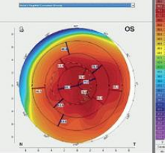 <p>large diameter, encompassing most of cornea</p>