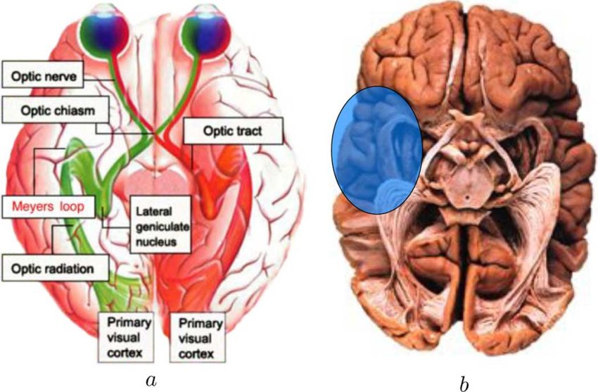 <ul><li><p>inferior lateral fibers of the LGN travel through the temporal lobe</p></li><li><p>form Meyer’s loop by looping around the lateral ventricle into the parietal lobe</p></li><li><p>terminate in V1 in the occipital lobe</p></li></ul><p>Lower (inferior) fibers travel Laterally in the optic tract and form meyer’s Loop before ending in the Lingual gyrus</p><p></p>