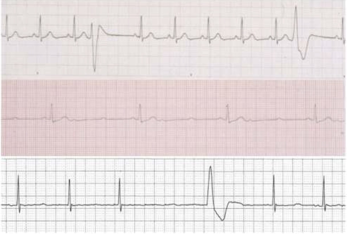<p>What are these three common arrhythmias seen in animals under anesthesia?</p>