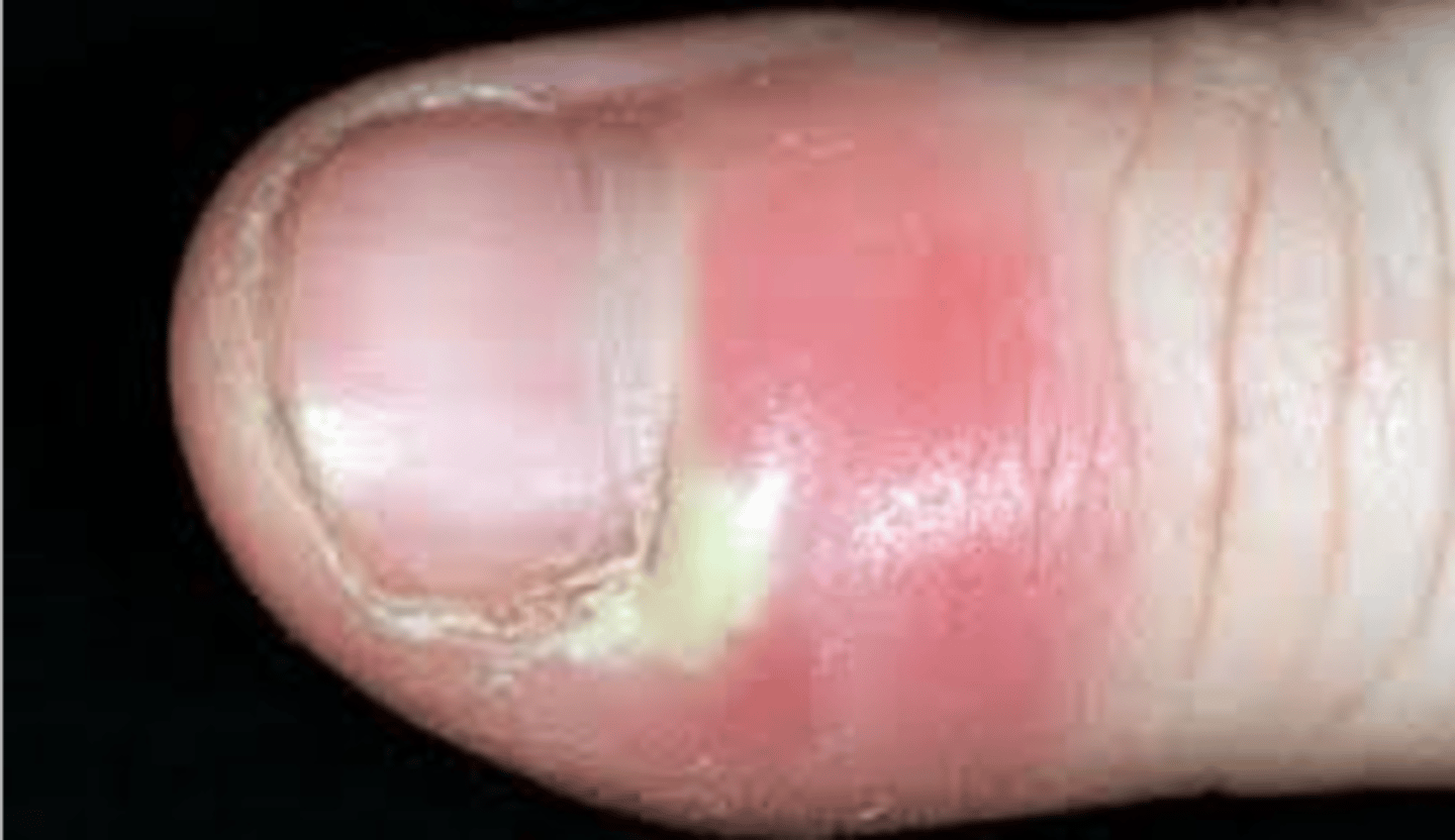 <p>name nail abnormality</p>