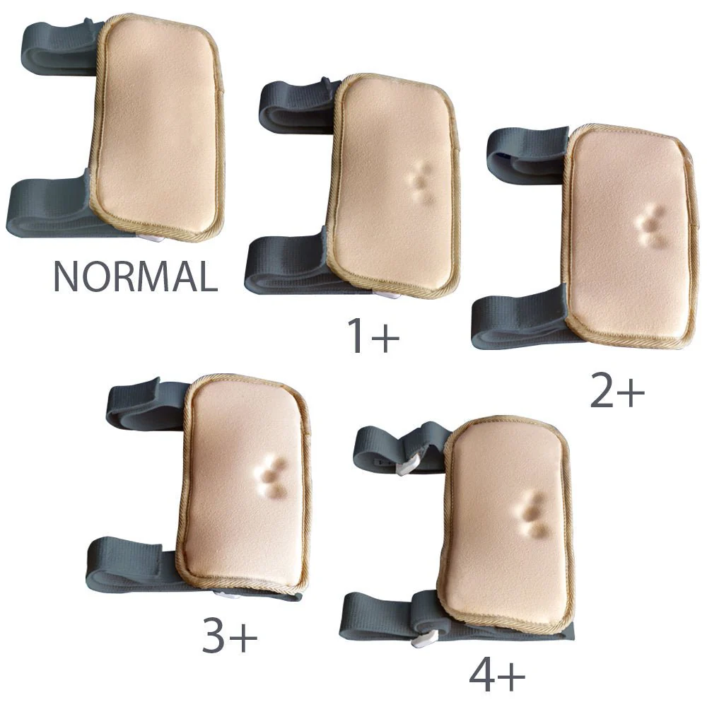 <p>A type of swelling that occurs when excess fluid accumulates in tissues, often caused by underlying health conditions, and is commonly assessed during medical simulations. </p>