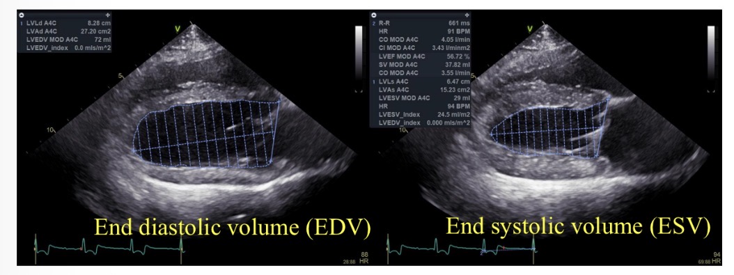 <p>Normal ejection fraction</p>