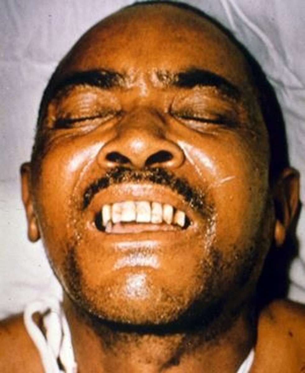 <p>A highly characteristic, abnormal, sustained spasm of the facial muscles that appears to produce grinning</p><p>Spasm of tetanus</p>