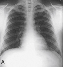 <p>Which of the following is the X-ray showing and why?</p><p>Sthenic</p><p>Hyposthenic</p><p>Asthenic</p><p>Hypersthenic</p>