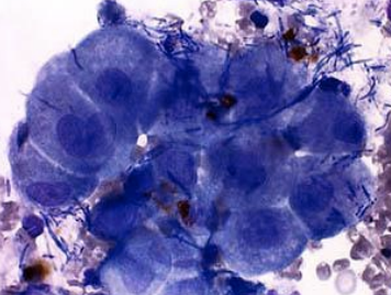 <p>What cells on an FNA have a round nucleus, round-ovoid-angular cytoplasm with distinct borders, exfoliating cells in sheets and clumps, and can form ducts and acini? They are indicative of carcinoma and adenocarcinoma.</p>