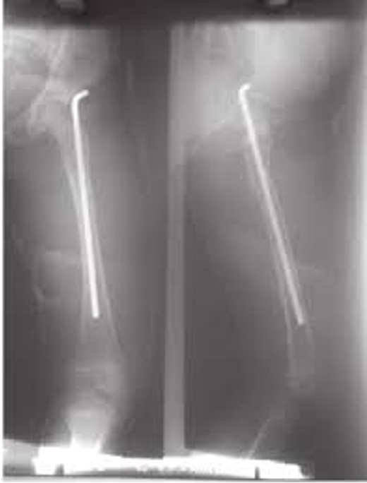 <ul><li><p>Fracture Stabilizers (For Pediatric Femurs)</p></li></ul><p></p>