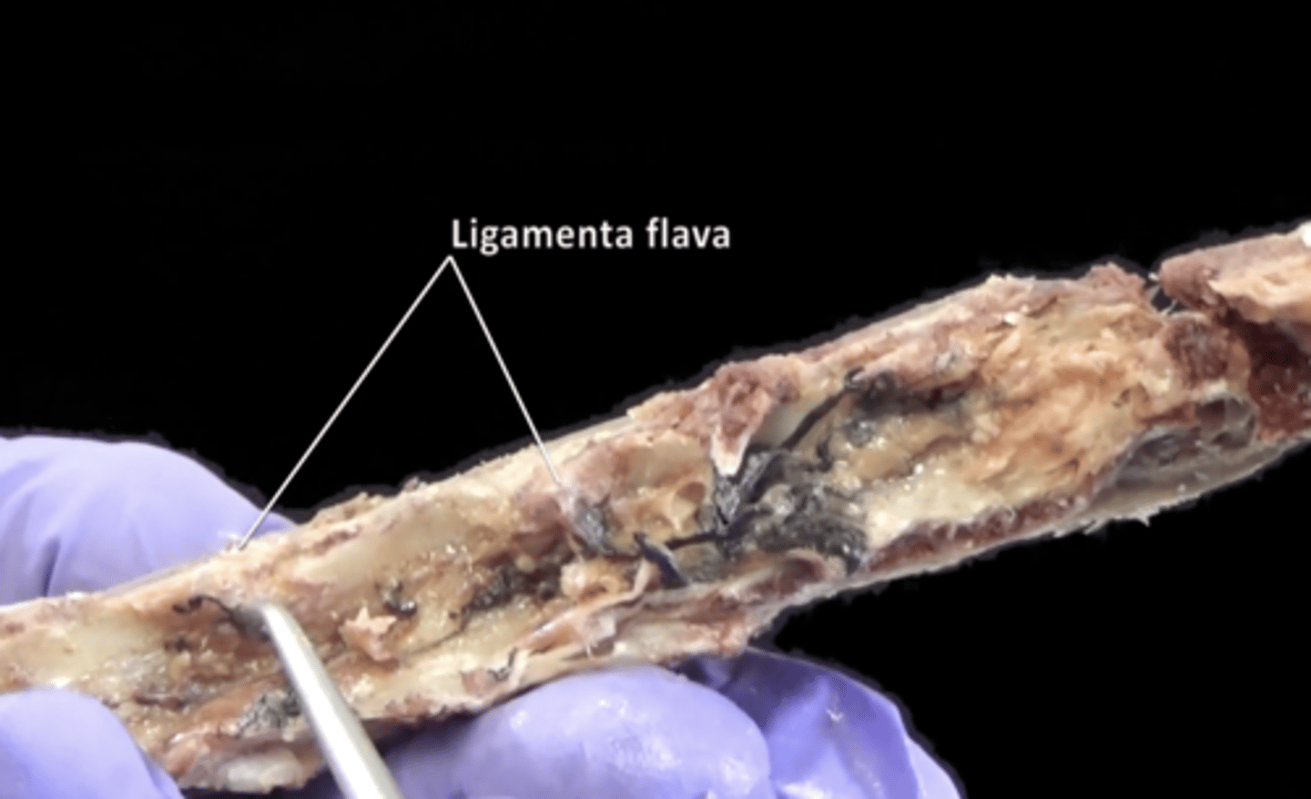<p>Elastic connective tissue connecting the laminae of adjacent vertebrae.</p>