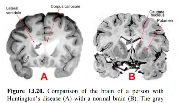 <p>What is one obvious sign of brain damage in Figure 13.20A? _______________________________ What is the plane of orientation of this figure? ____</p>