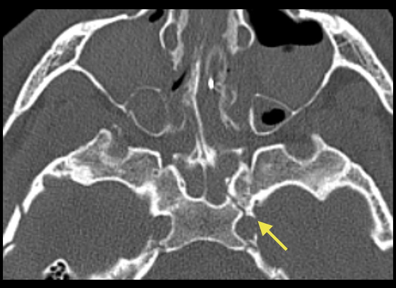 <p>C’est une fracture rarement isolée donc il faut chercher d’autres foyers de fracture ainsi qu’une atteinte du canal carotidien.</p>
