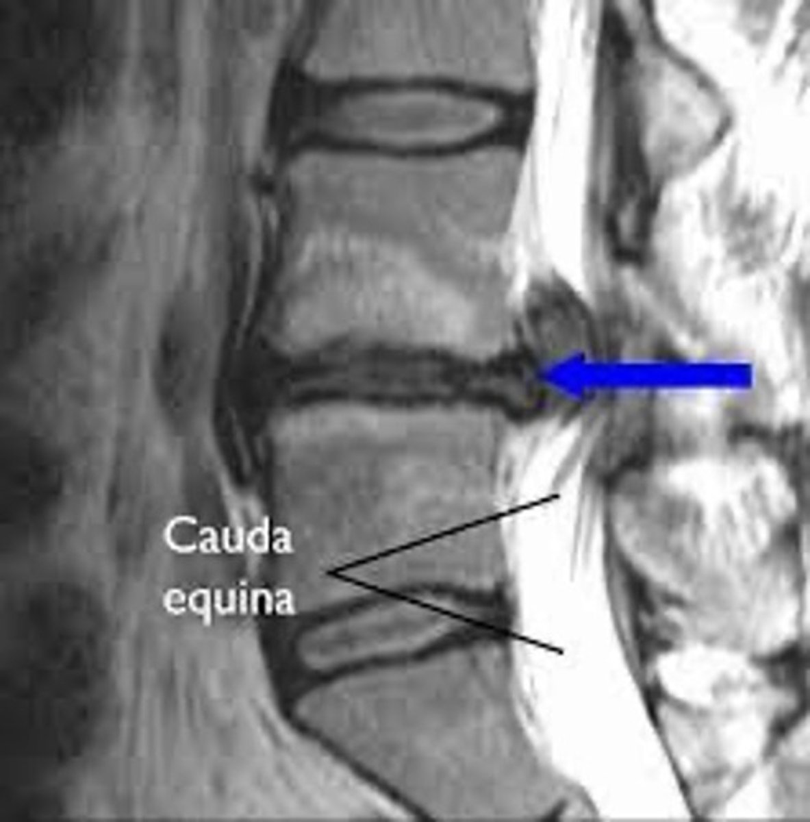 <p>etiology</p><p>(cauda equina)</p>