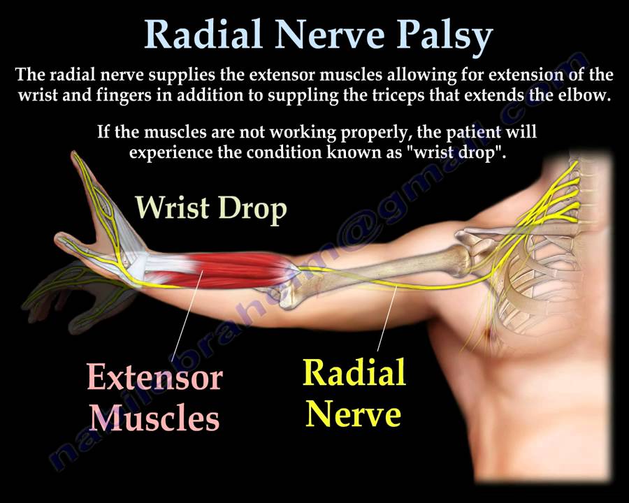 <p>-compression on the radial nerve on the upper arm</p><p><strong>-can also be caused by humerus fx </strong><br>-weakness/paralysis of extensors wrist,MCP, thumb<br><br>Conservative tx (<strong>dynamic wrist/MCP ext splint</strong>, strengthening of wrist/finger extensors)<br><br>Post op tx (AROM, strength 6-8wk, <strong>avoid pronation/ elbow extension/ wrist flexion together</strong>)</p>