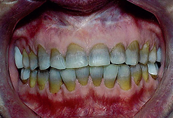 <p>Cross the placenta and are deposited in fetal bones and teeth.</p>