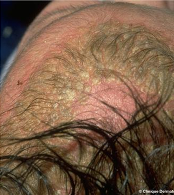 <p>Infantile Seborrheic Dermatitis </p>