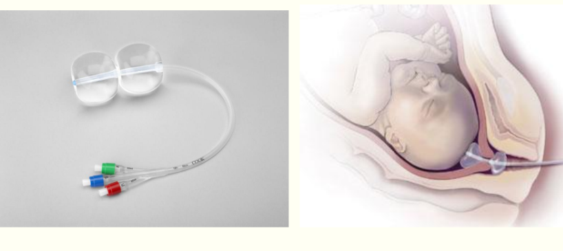 <p>cervical ripening balloon&nbsp;</p><p>opens up the cervix more</p>