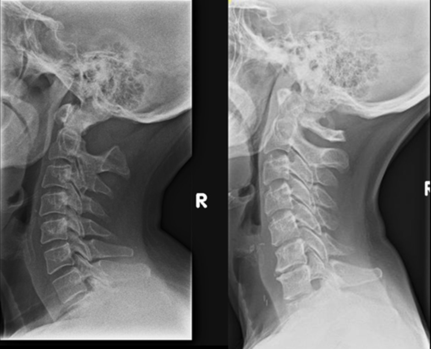 <p>_____ radiographic findings of agenesis of posterior arch:</p><p>- Hypertrophy of the anterior tubercle</p><p>- Enlargement of the C2 spinous process (megaspinous of C2)</p>