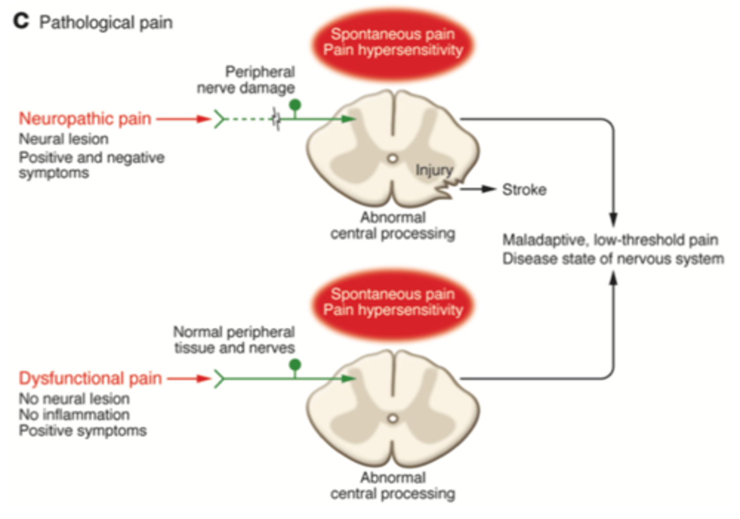 <p>Maladaptive pain due to abnormal function in NS. Can be due to:</p><p>- damage to nervous system (neuropathic)</p><p>- or by its own abnormal function (nociplastic).</p><p>-Does not have a protective function</p>
