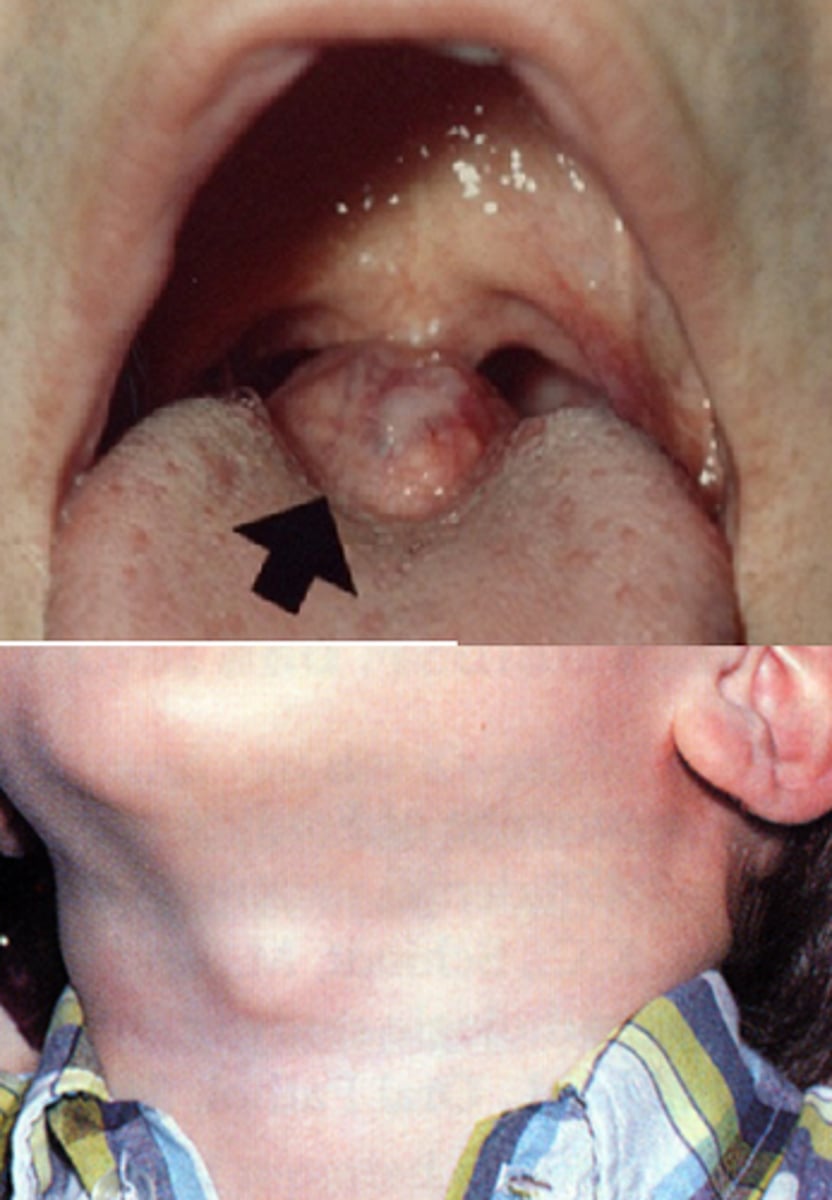 <p>1. neck - at midline</p><p>2. posterior tongue</p>