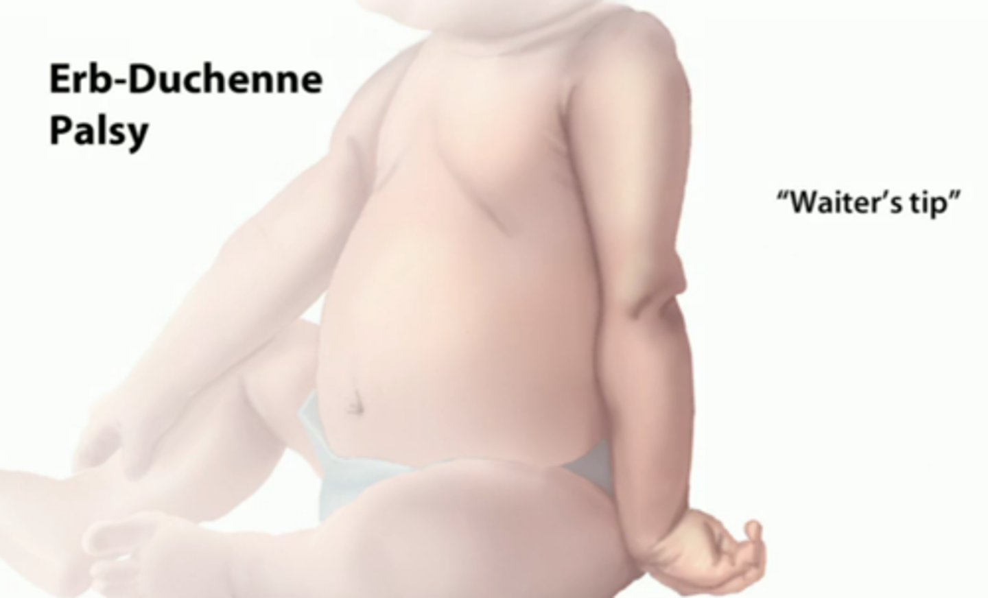 <p>What: C5-C6 nerve root stretched during birthing process</p><p>Clinical presentation</p><p>-decreased shoulder girdle function with 1:1 humeroscapular movement</p><p>-weakness in scapular stabilizers, GH ABD and ER and elbow flexion and supination</p><p>-Posture = arm is ADD and IR (waiter's tip)</p>