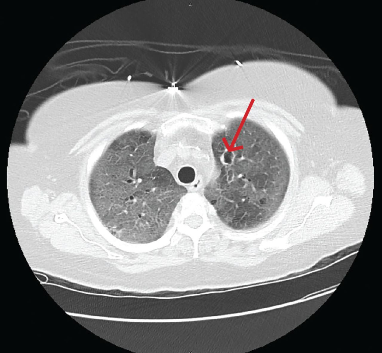 <p>What is invasive aspergillosis?</p>