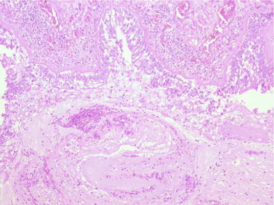 <p><span>Insert at 10x magnification: section of asthmatic bronchi showing epithelium that has been sloughed off and a mucus plug in the lumen. Label the basement membrane, epithelium, mucus plug and inflammatory cells in the mucus.</span></p>