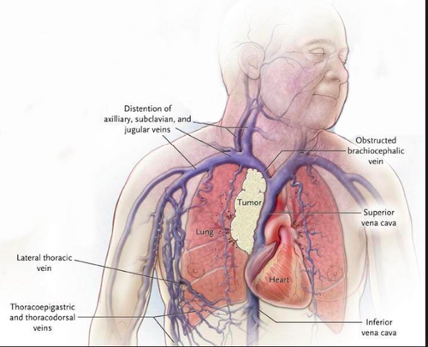 <p>Superior vena cava (SVC) syndrome</p><p>- malignancy most common cause obstruction (lung cancer small cell, nonHodgkin lymphoma)</p><p>- x-ray chest, followup with chest CT and histo</p>