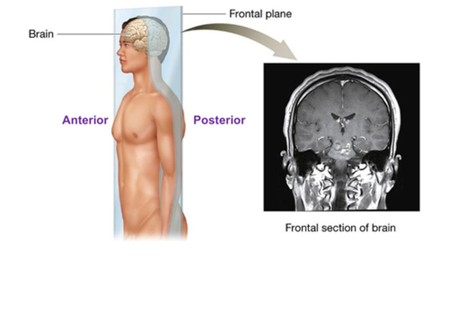 <p>The ________________ plane (also called the coronal plane) divides the body into anterior and posterior sections.</p><p>A) Sagittal</p><p>B) Transverse</p><p>C) Frontal</p><p>D) Oblique</p>