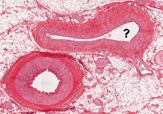 <p>Is this a vein or an artery?</p>