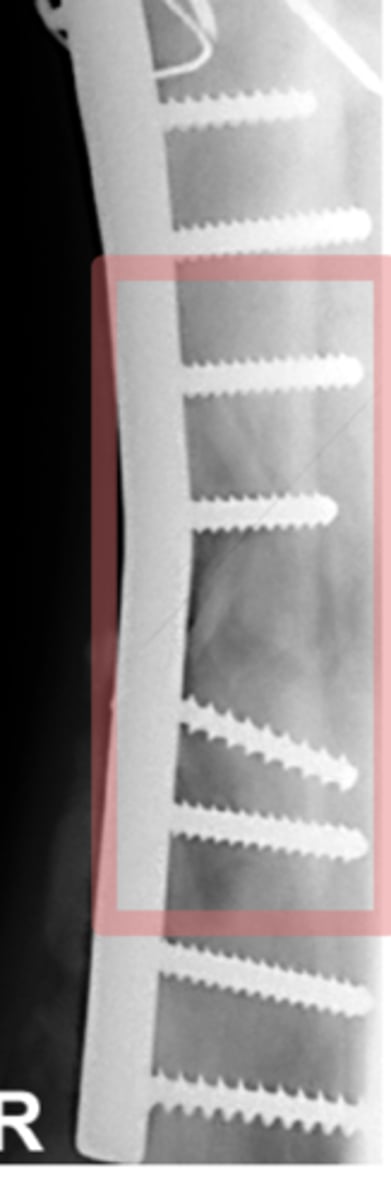 <p>What does the following lesion suggest?</p>